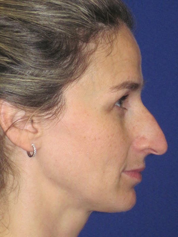 Rhinoplasty Before & After Gallery - Patient 11110025 - Image 1