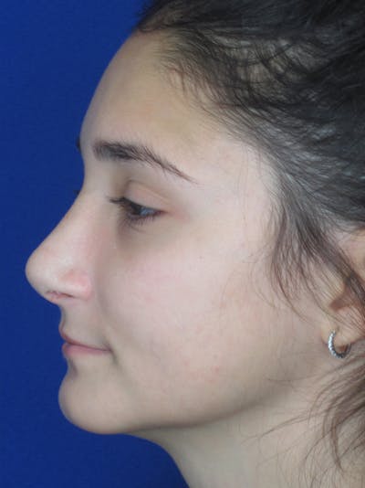 Rhinoplasty Before & After Gallery - Patient 11110024 - Image 8