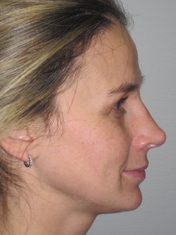 Rhinoplasty Before & After Gallery - Patient 11110025 - Image 2