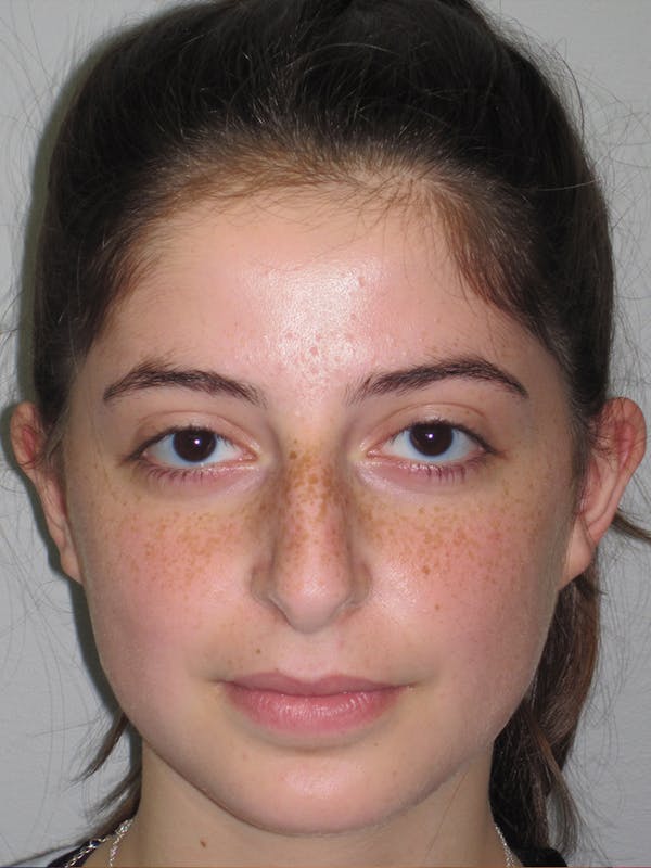 Rhinoplasty Before & After Gallery - Patient 11110054 - Image 3