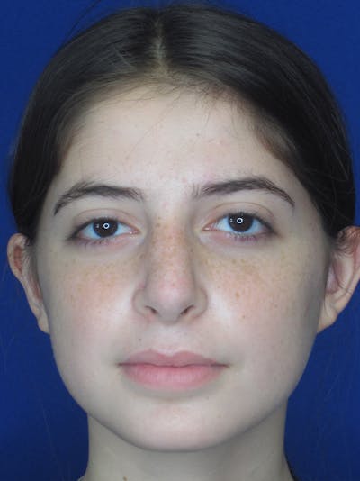 Rhinoplasty Before & After Gallery - Patient 11110054 - Image 4