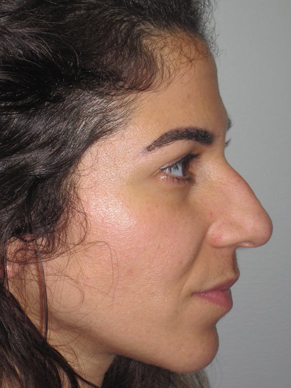 Rhinoplasty Before & After Gallery - Patient 11110053 - Image 1