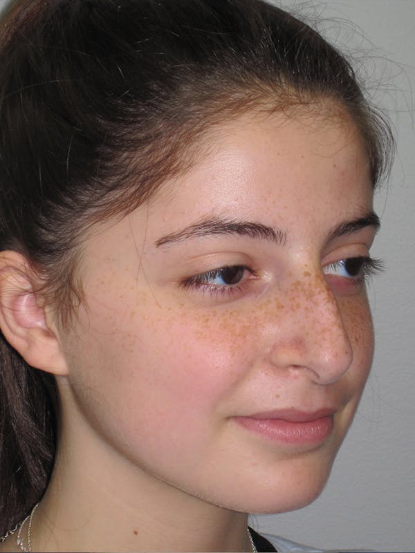 Rhinoplasty Before & After Gallery - Patient 11110054 - Image 5