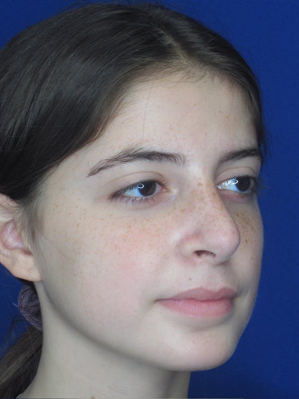 Rhinoplasty Before & After Gallery - Patient 11110054 - Image 6