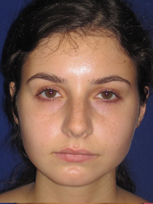 Rhinoplasty Before & After Gallery - Patient 11110055 - Image 5