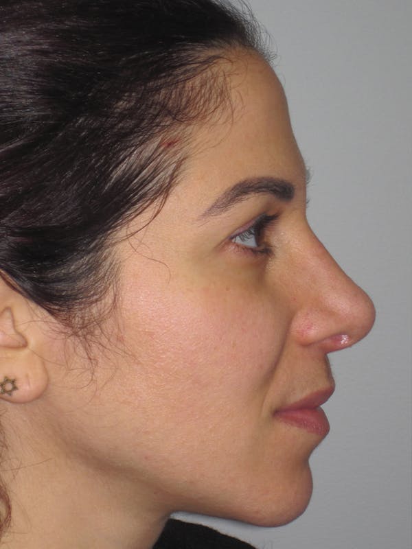 Rhinoplasty Before & After Gallery - Patient 11110053 - Image 2