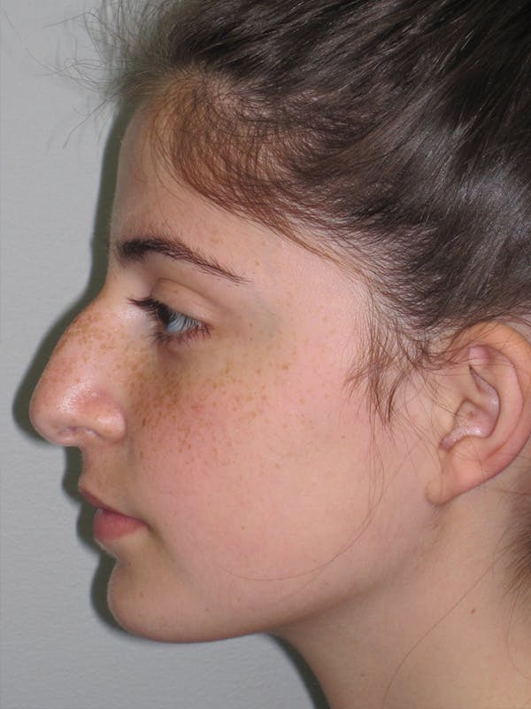 Rhinoplasty Before & After Gallery - Patient 11110054 - Image 1