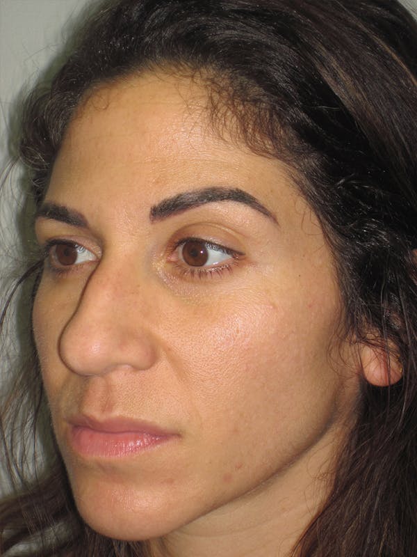 Rhinoplasty Before & After Gallery - Patient 11110053 - Image 7