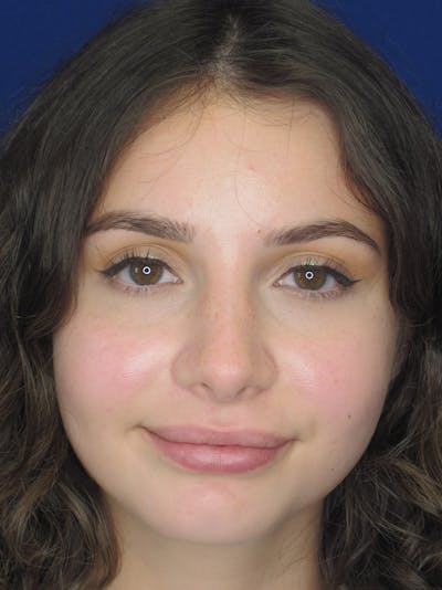 Rhinoplasty Before & After Gallery - Patient 11110055 - Image 6