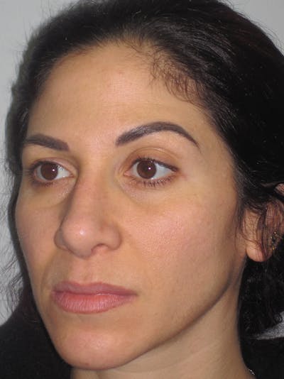 Rhinoplasty Before & After Gallery - Patient 11110053 - Image 8