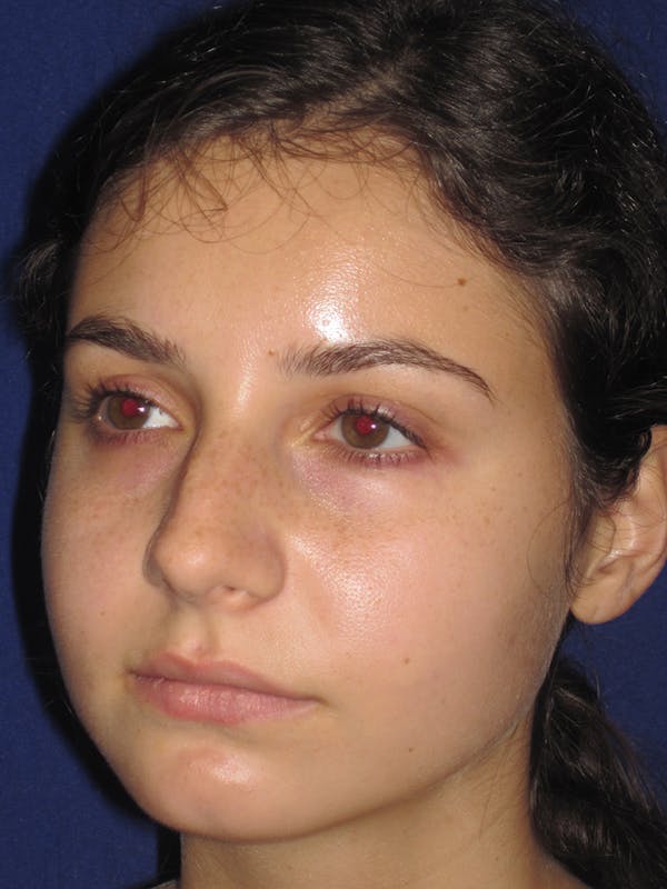 Rhinoplasty Before & After Gallery - Patient 11110055 - Image 3