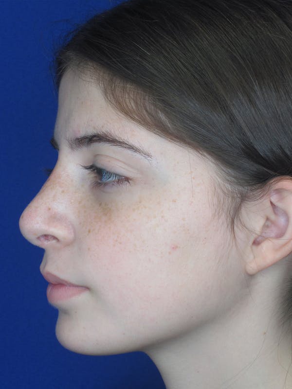 Rhinoplasty Before & After Gallery - Patient 11110054 - Image 2