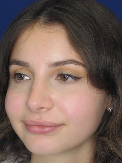 Rhinoplasty Before & After Gallery - Patient 11110055 - Image 4