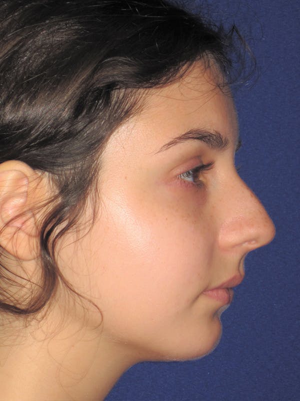 Rhinoplasty Before & After Gallery - Patient 11110055 - Image 1