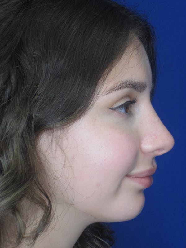 Rhinoplasty Before & After Gallery - Patient 11110055 - Image 2