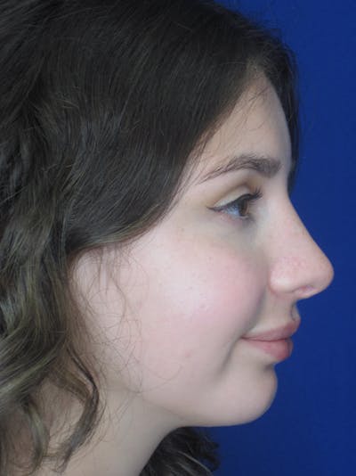 Rhinoplasty Before & After Gallery - Patient 11110055 - Image 2