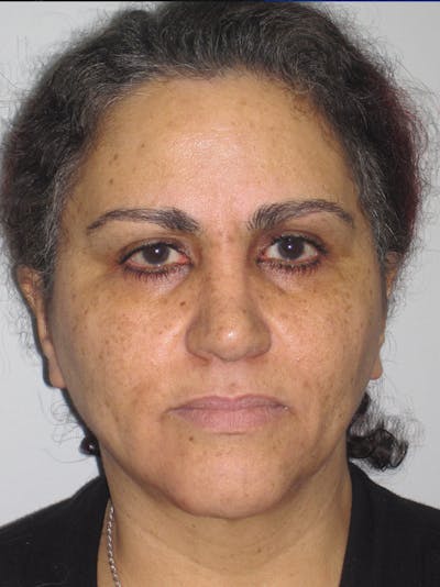 Facelift/Mini-Facelift Before & After Gallery - Patient 11110071 - Image 1