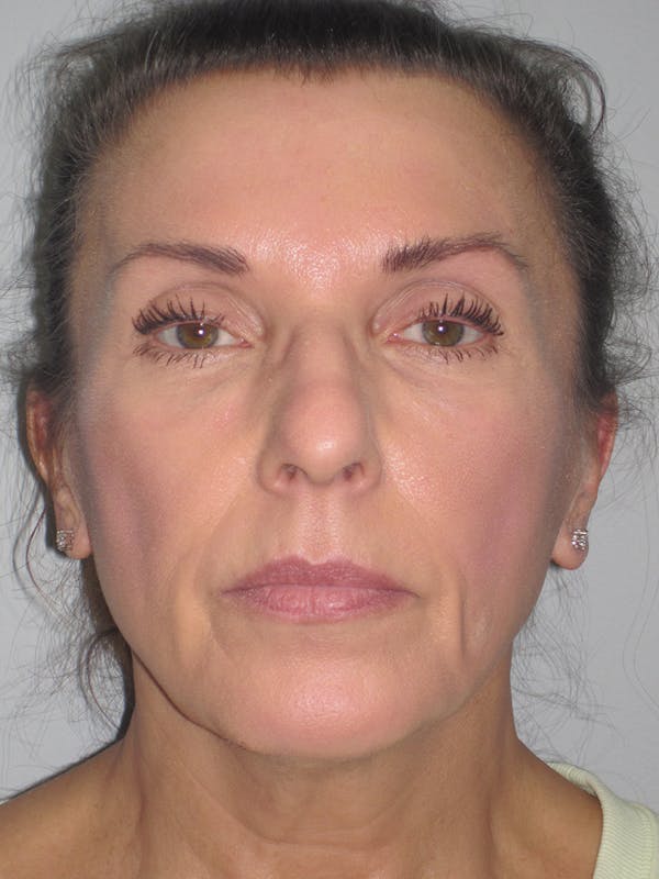 Facelift/Mini-Facelift Before & After Gallery - Patient 11110072 - Image 5