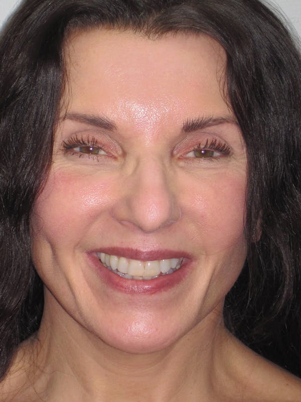 Facelift/Mini-Facelift Before & After Gallery - Patient 11110072 - Image 6