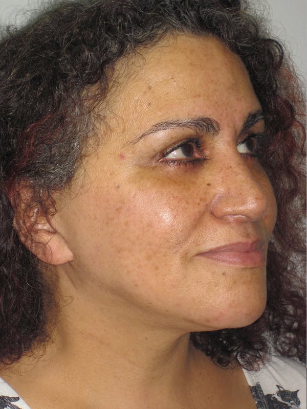 Facelift/Mini-Facelift Before & After Gallery - Patient 11110071 - Image 4