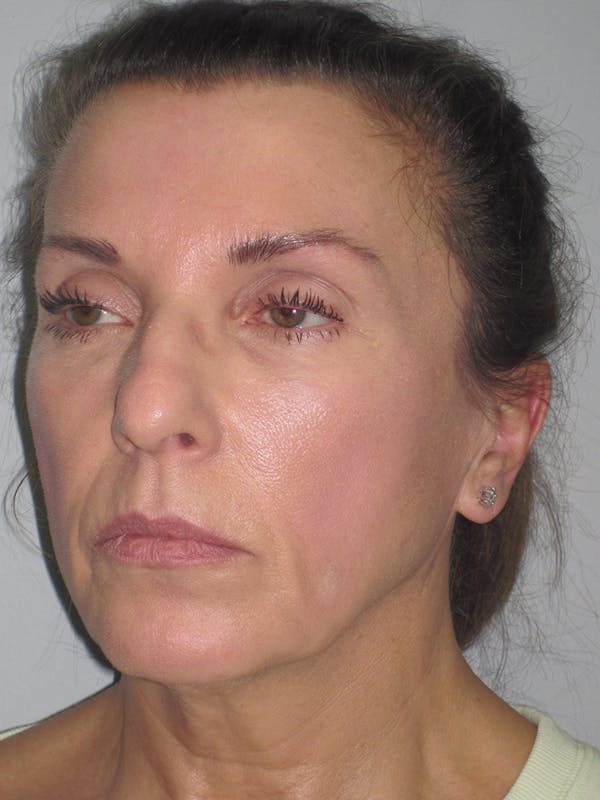 Facelift/Mini-Facelift Before & After Gallery - Patient 11110072 - Image 3