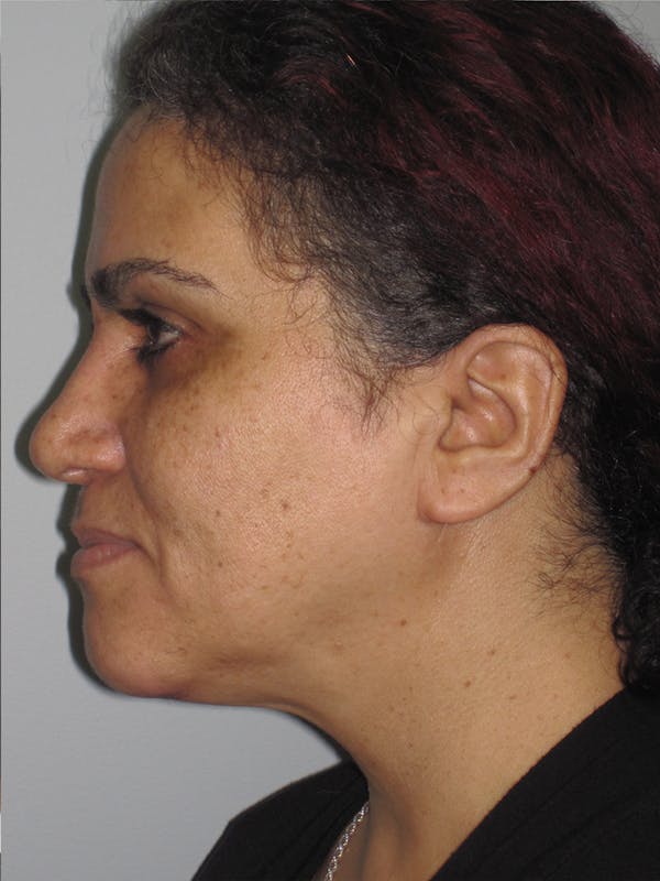 Facelift/Mini-Facelift Before & After Gallery - Patient 11110071 - Image 5
