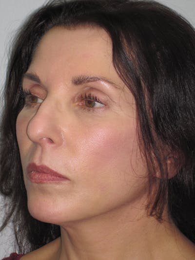 Facelift/Mini-Facelift Before & After Gallery - Patient 11110072 - Image 4