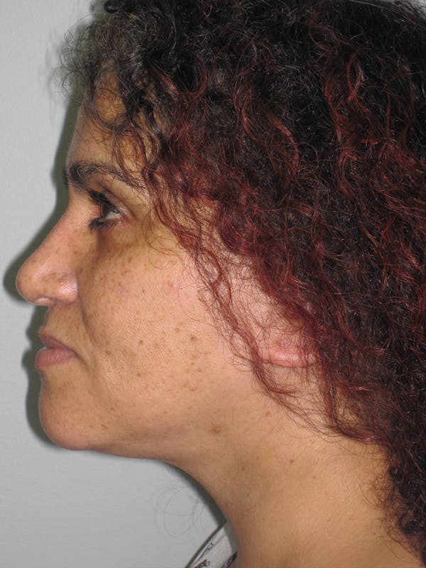 Facelift/Mini-Facelift Before & After Gallery - Patient 11110071 - Image 6