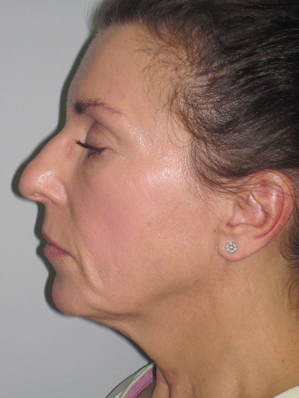 Facelift/Mini-Facelift Before & After Gallery - Patient 11110072 - Image 7