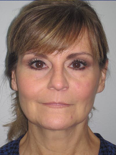 Facelift/Mini-Facelift Before & After Gallery - Patient 11110073 - Image 1