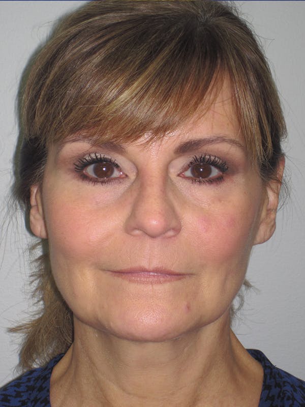 Facelift/Mini-Facelift Before & After Gallery - Patient 11110073 - Image 1