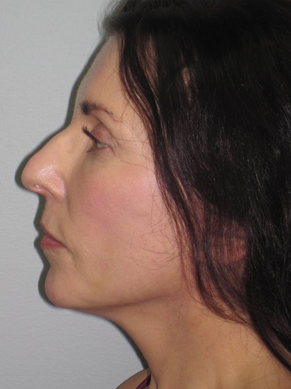 Facelift/Mini-Facelift Before & After Gallery - Patient 11110072 - Image 8