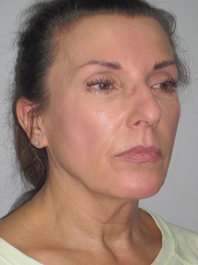 Facelift/Mini-Facelift Before & After Gallery - Patient 11110072 - Image 1