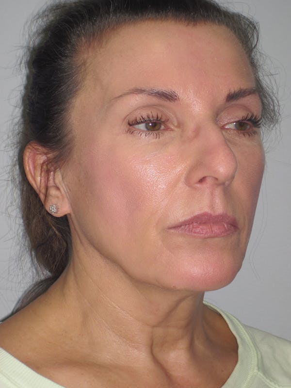 Facelift/Mini-Facelift Before & After Gallery - Patient 11110072 - Image 1