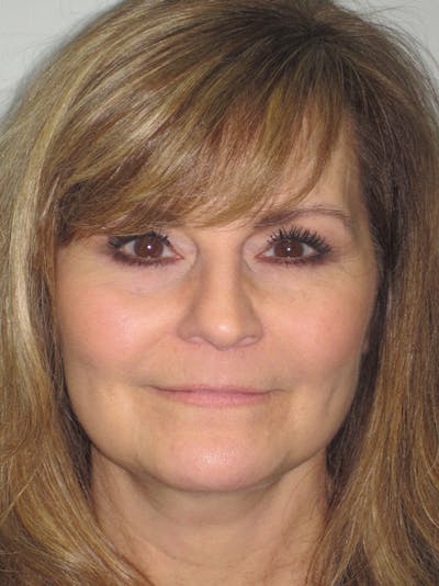 Facelift/Mini-Facelift Before & After Gallery - Patient 11110073 - Image 2