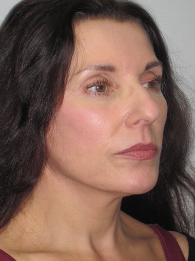 Facelift/Mini-Facelift Before & After Gallery - Patient 11110072 - Image 2