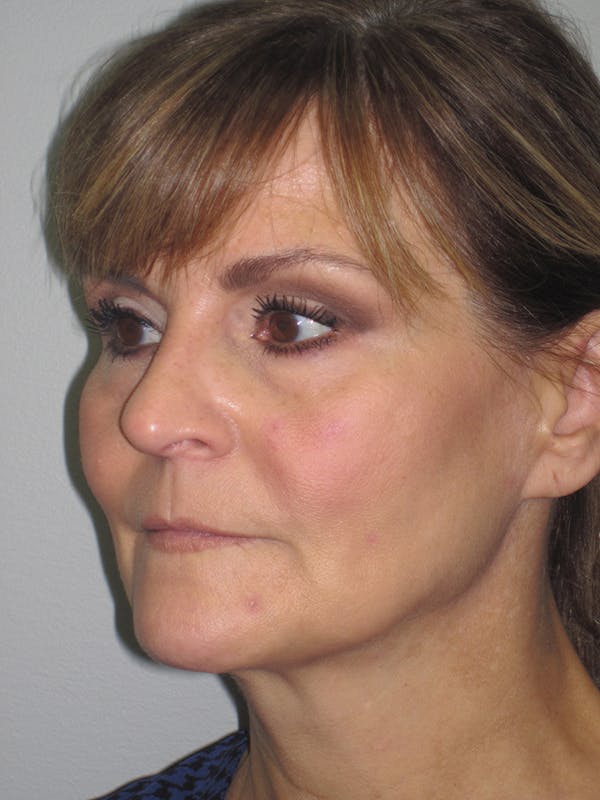Facelift/Mini-Facelift Before & After Gallery - Patient 11110073 - Image 3