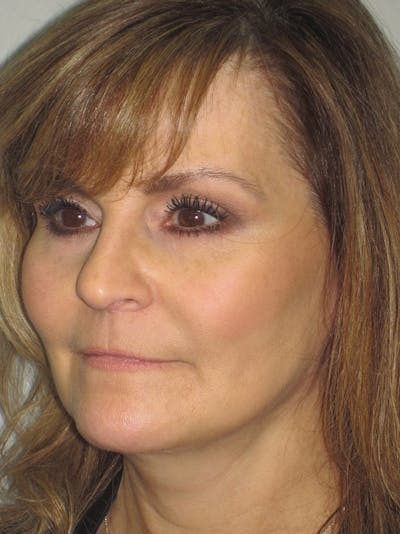 Facelift/Mini-Facelift Before & After Gallery - Patient 11110073 - Image 4