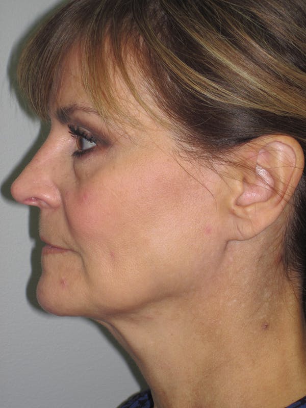 Facelift/Mini-Facelift Before & After Gallery - Patient 11110073 - Image 5