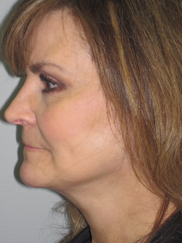 Facelift/Mini-Facelift Before & After Gallery - Patient 11110073 - Image 6