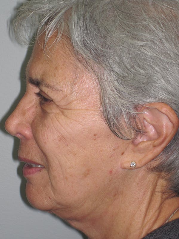 Laser Skin Resurfacing Before & After Gallery - Patient 11110081 - Image 5