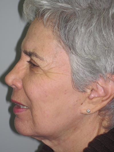 Laser Skin Resurfacing Before & After Gallery - Patient 11110081 - Image 6