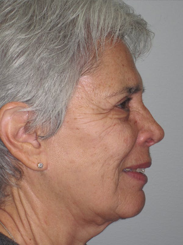 Laser Skin Resurfacing Before & After Gallery - Patient 11110081 - Image 3