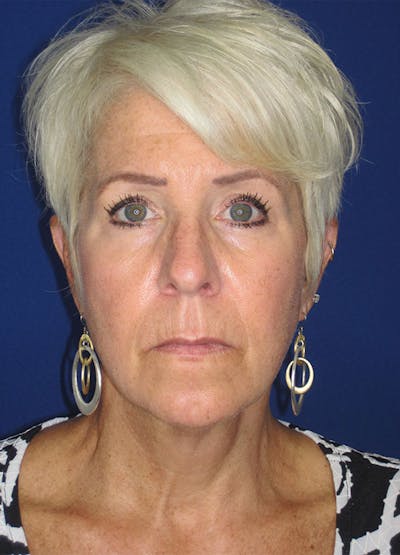 Facelift/Mini-Facelift Before & After Gallery - Patient 91755406 - Image 1
