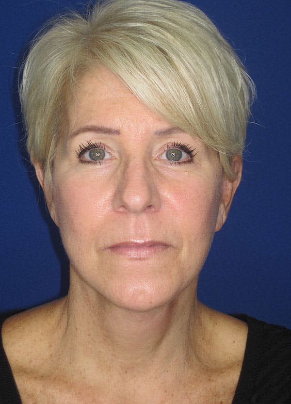 Facelift/Mini-Facelift Before & After Gallery - Patient 91755406 - Image 2