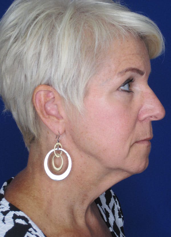 Facelift/Mini-Facelift Before & After Gallery - Patient 91755406 - Image 3