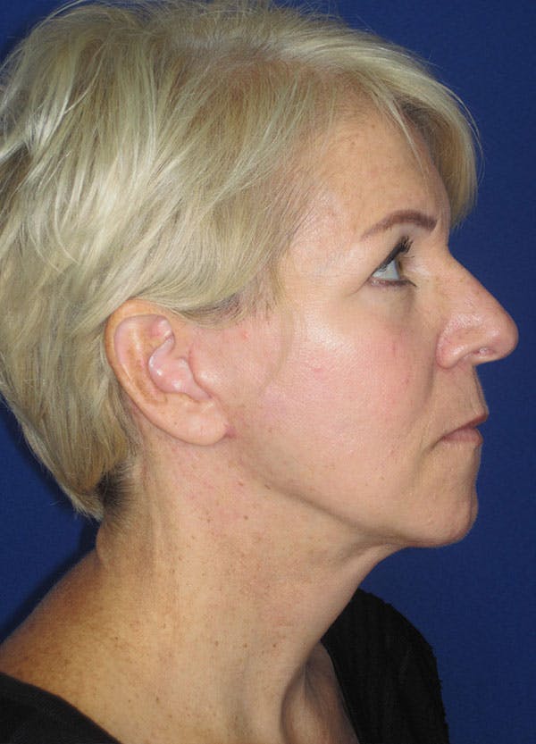 Facelift/Mini-Facelift Before & After Gallery - Patient 91755406 - Image 4
