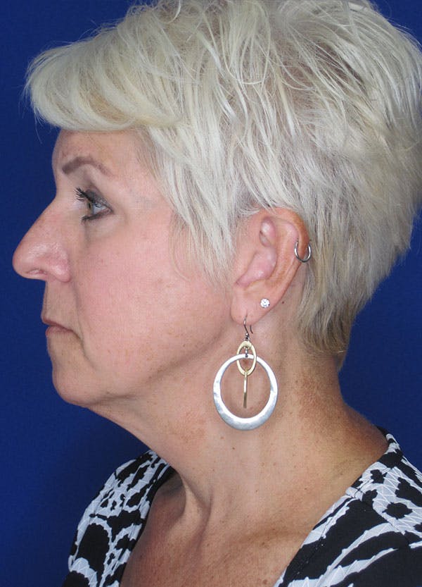 Facelift/Mini-Facelift Before & After Gallery - Patient 91755406 - Image 5