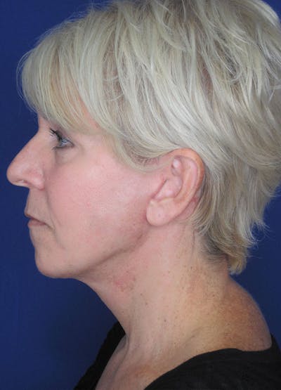 Facelift/Mini-Facelift Before & After Gallery - Patient 91755406 - Image 6