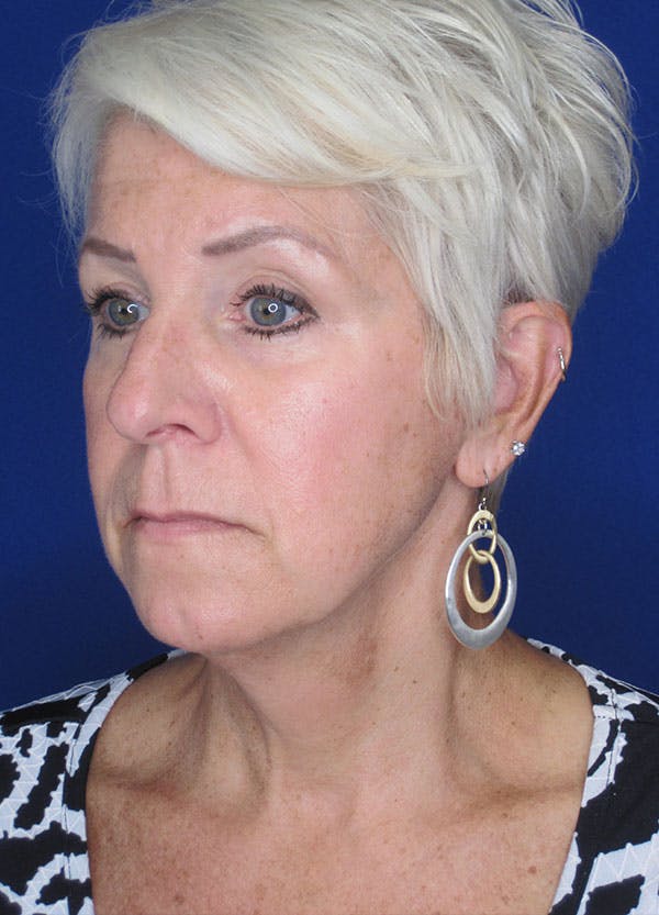 Facelift/Mini-Facelift Before & After Gallery - Patient 91755406 - Image 7